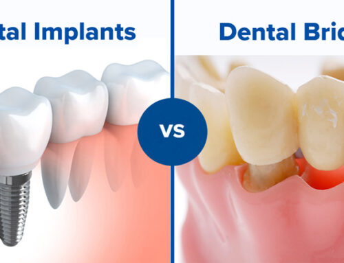 What’s Better: A Dental Implant or a Bridge?